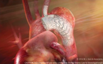 고어 태그 흉부 내장 가지 인공삽입물(TBE)에 대한 주요 임상연구에서 최초 삽입 성공